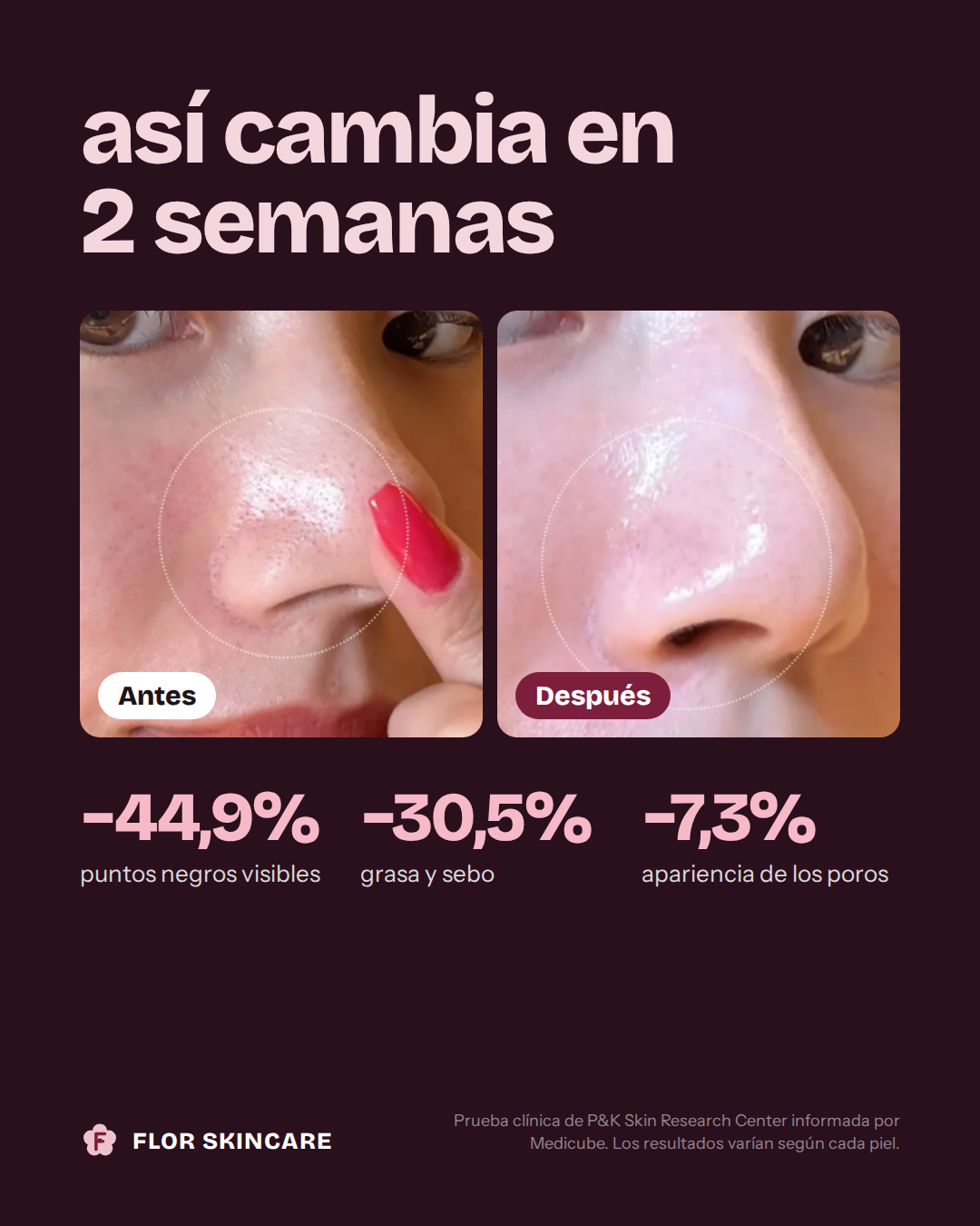 Antes y después en 2 semanas: menos puntos negros, grasa y poros visibles